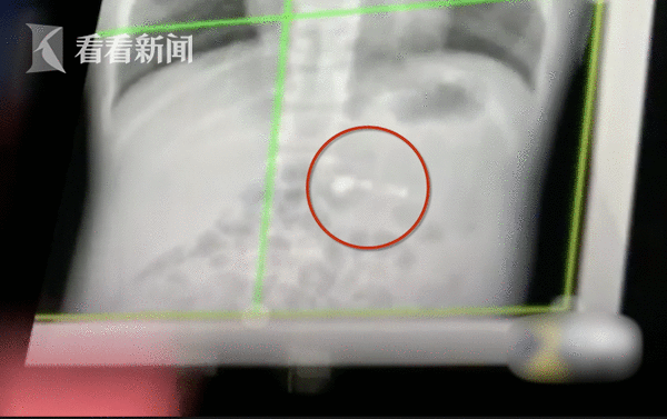 7岁男孩误吞AirPod医生建议自行排出
